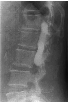 Fig. 2. A lateral view of the myelogram. There is no communication be- be-tween the cyst and subarachnoid space.