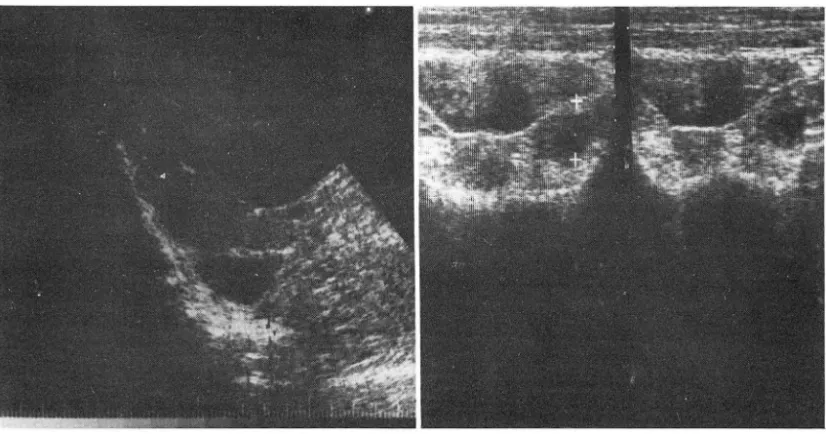 Fig.  2.  T ype  II  pattern 
