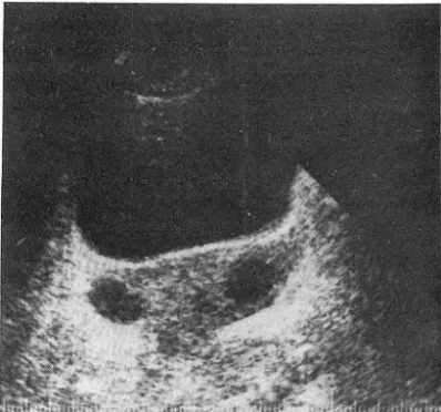 Table 3.  Ultrasonographic  and  pathologic  correlation 