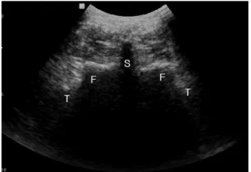 Fig. 3. Target facet segment can be counted by longitudinal paravertebral  sonogram corresponding with previously checked spinous process