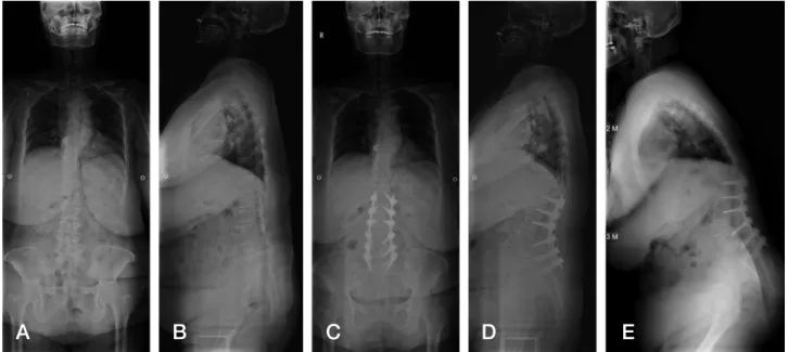 Fig. 1. Serial five whole spine x-ray shows initial, postoperative &amp; last follow-up changes of spinopelvic parameters on non-iliac screw group