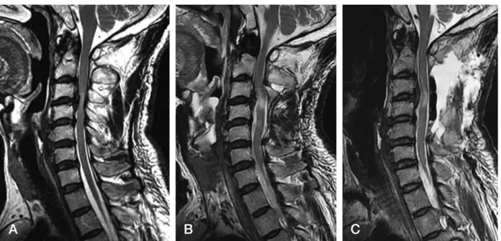Fig. 3. 71-year-old man with multilevel spondylosis. (A, B) Preoperative lateral radiogram and  sagittal reconstruction CT scan show some loss of  lordosis and a posterior continuous configuration at the vertebral bodies of C3-5
