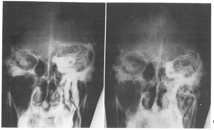 Fig.  2.  Case  II. 