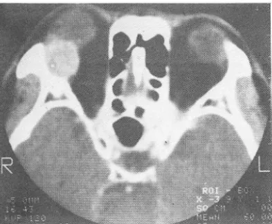 Fig.  1.  Pleomorphic  adenoma, post-contrast  scan, 51/M  Well  defined  homogeneously  e nhancing  mass  in  right lacrimal fossa with pressure erosion of lateral  orbital wall  A  Fig