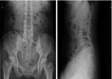 Fig. 1. Preoperative simple radiographs show retrolisthesis of and spon- spon-dylolisthesis of L3 on L4.