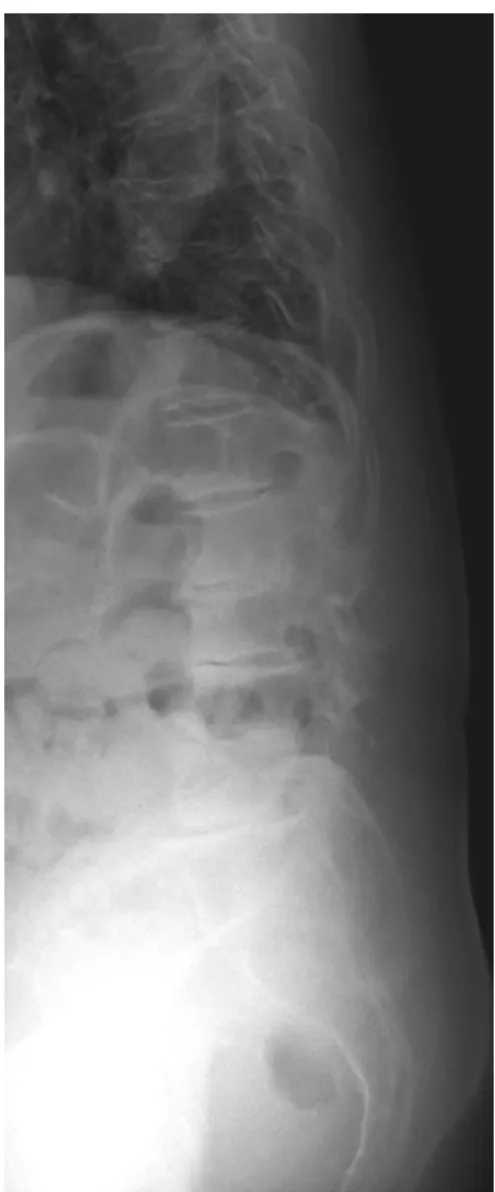 Fig. 1. Multiple level degenerative disease (narrowing of the interverta- interverta-bral) space and central vacuum phenomenon at lateral radiograph of the  lumbar spine.