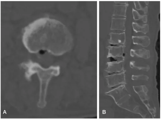 Fig. 5. L3-4 Immediate post operative computed tomography demonstrate an air bubble within the anterior  parth of the epidural space (A)