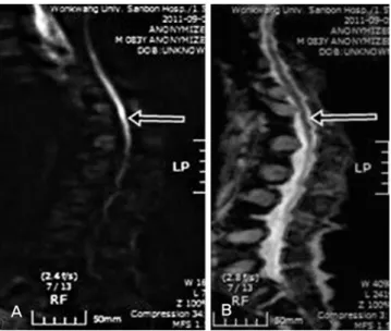 Fig. 1. (A) T2-weighted sagittal image shows a strip like intramedullary high-signal intensity in the spinal cord