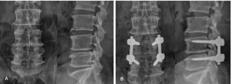 Fig. 3. (A) A 56-year-old male’s preoperative simple radiograph shows spinal stenosis L4-5