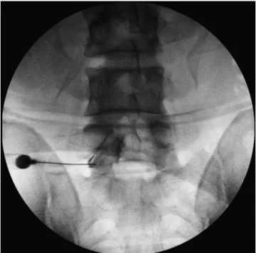 Fig. 1. Fluorography shows the contrast flowing through the spinal canal.   Fig. 2. Fluorography shows contrast extending to proximal and distal por- por-tion of L5 nerve root but not the spinal canal.