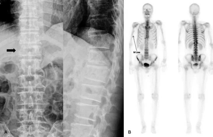 Fig. 1. (A) TL spine AP &amp; lateral radiographs shows the loss of right side pedicle and collapse of T12 (arrow)