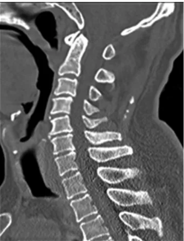 Fig. 4. Sagittal T2 MRI of D-L spine. Showing increased signal intensity  from T5 to T12.