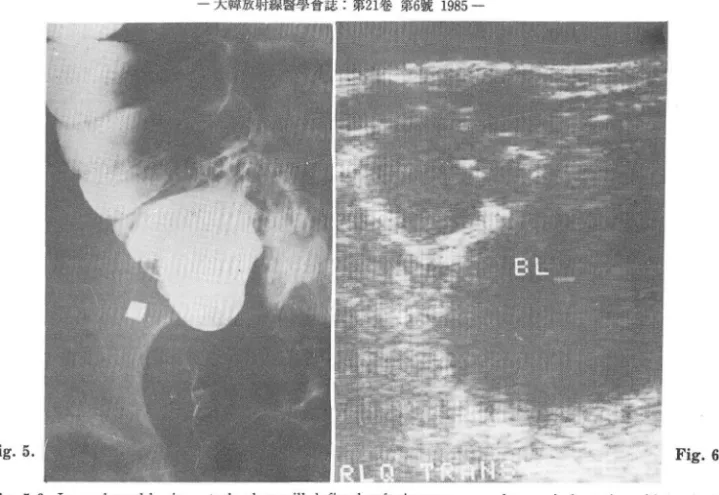 Fig.  5 , 6.  Large bowel  barium study shows ill  defined  soft  tissue mass  and  some  indentation of lateral  side of cecum