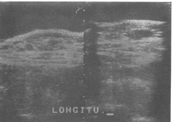 Fig.  8.  Longitudinal scan of  Lt.  thigh demonstrates ill defined cystic mass and some in- in-ternal  echo