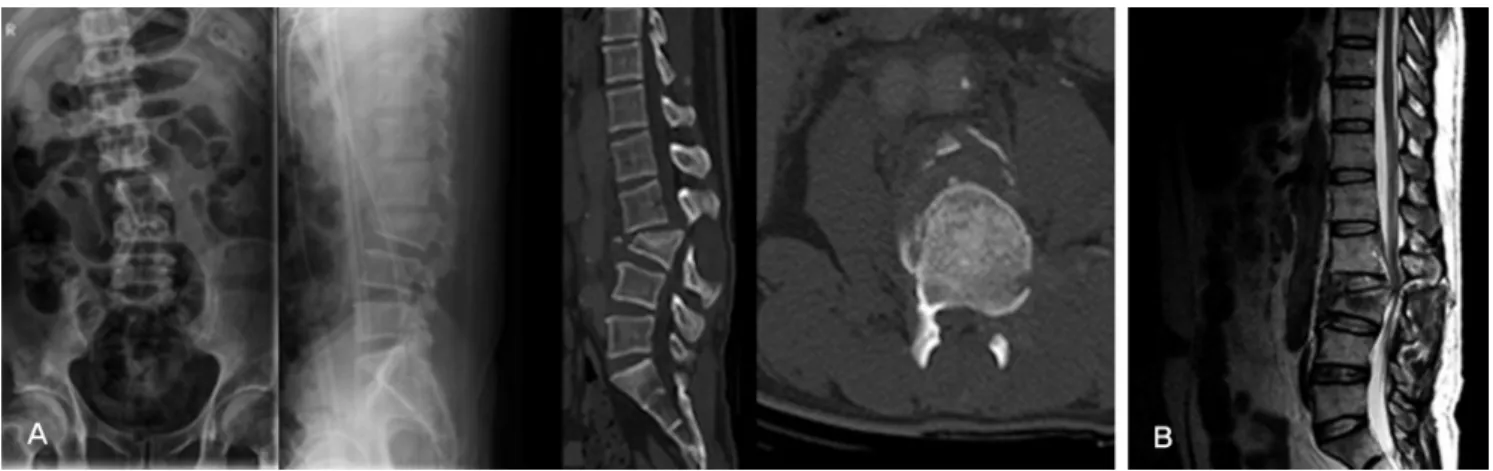 Fig. 2. First staged operation was done a method of postural reduction  and minimally invasive percutaneous pedicle screw fixation