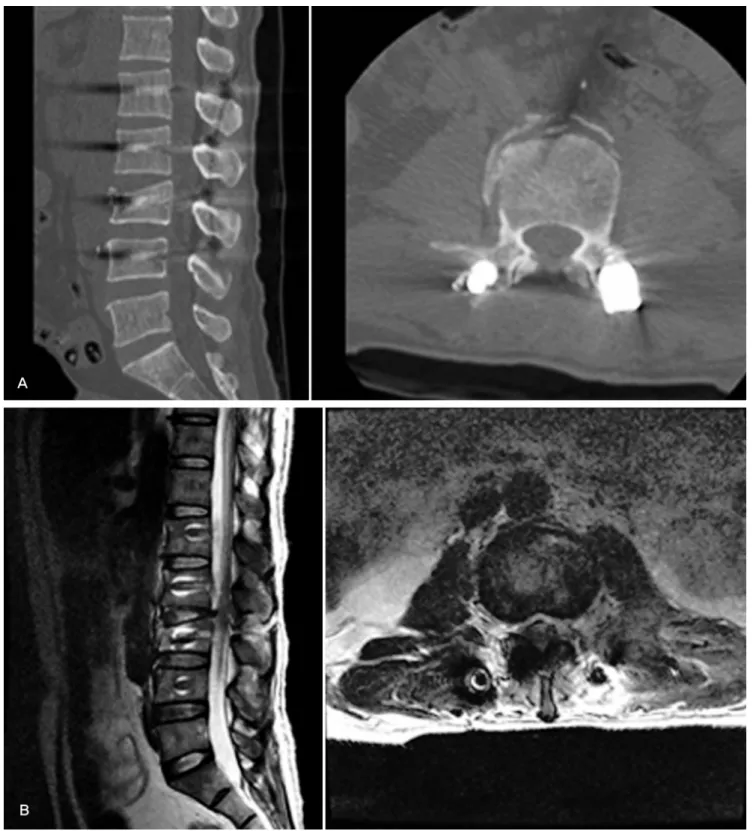 Fig. 3. (A) Post operative(two weeks after first stage operation) reconstruction CT demonstrate correction of sagittal balance with facet joint reduction (B)  postoperative(two weeks after first stage operation) MRI sagittal and axial image demonstrate can