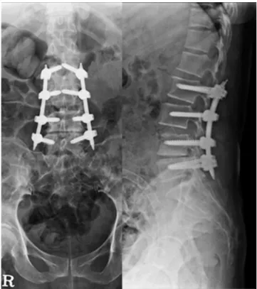Fig. 4. Second staged operation was done a method of partial laminec- laminec-tomy, discectomy and posterior fusion 