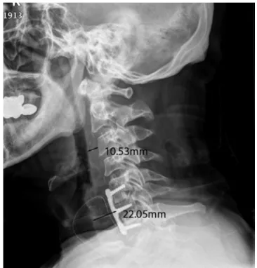 Fig. 2. postoperative serial x-rays (post op 1day 07:00)