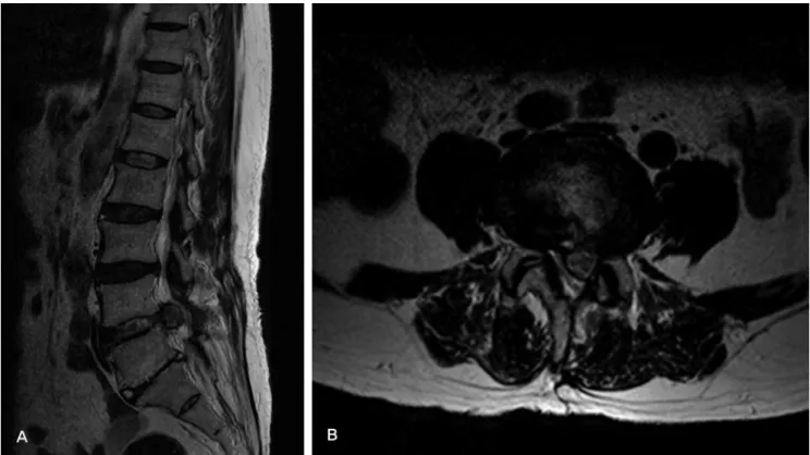 Fig. 2. T2-weighted sagittal (A) and axial (B) MR image of 54 years old female patient with bladder dysfuction, motor weakness and sensory deficit of  left leg, it shows a case of cauda equina injury by relapsed lumbar disc herniation after open discectomy