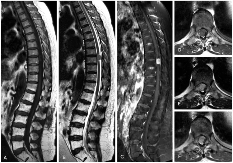 Fig. 1. The tumor is located at the T8-9 level. (A) T1-weighted sagittal MR image shows peripheral low signal intensity and central iso-signal intensity  mass