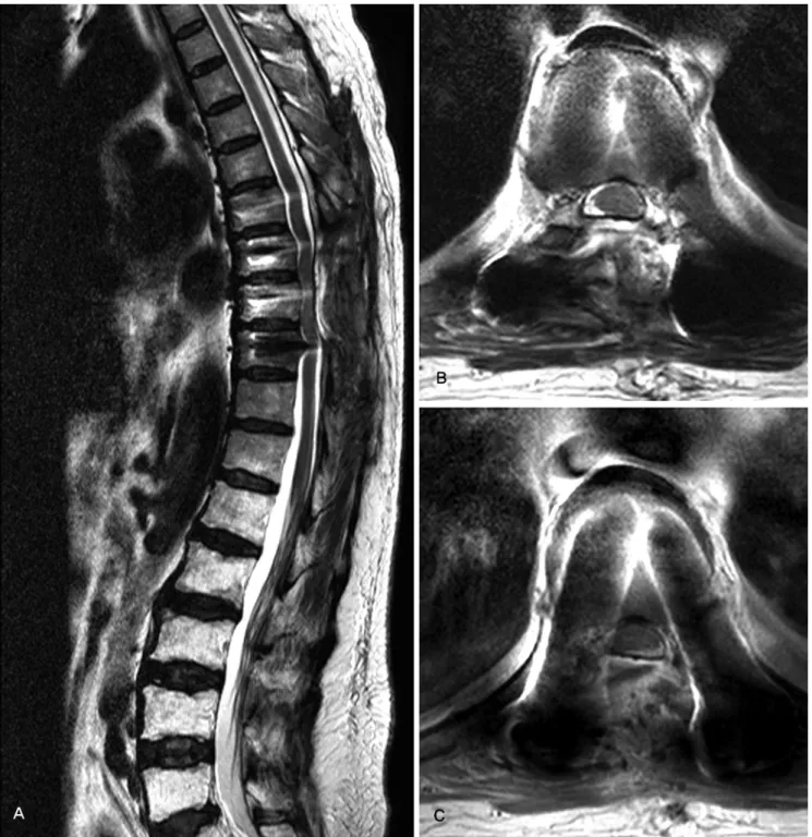 Fig. 4. Follow-up MR image was checked for 4 weeks after operation. (A) T2-weighted sagittal MR image shows complete removal of cord compression  lesion