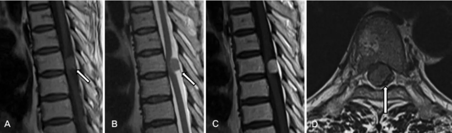 Fig. 1. Preoperative MRI revealed solid intradural, extramedullary tumor measuring 1cm in diameter located at the level of T6 spinal canal