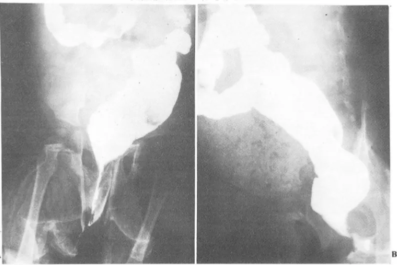 Fig.  1.  A &amp;  B Fecal materials in  duplicated rectosigmoid colon were located anterior to normally barium filled  rectosigmoid colon  on  barium enema 