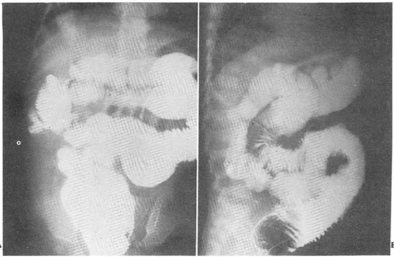 Fig.  3.  A  &amp;  B Duplicated colon  run para Jl el to the normal colon from  cecum to  rectum on  postsurgical barium  enema