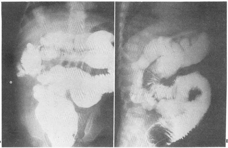Fig.  3.  A  &amp;  B Duplicated colon  run para Jl el to the normal colon from  cecum to  rectum on  postsurgical barium  enema