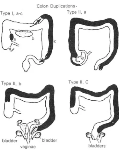 Fig. 5.  Diagrammatic representation of colon duplications .  Type  1  duplications  may  be  (a)  spherical ,  (b) 