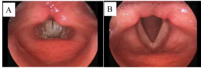 표 2.  변성발성장애 환자들의 특징적인 후두소견 변화 (n=26) Table  2.  Changes  of  laryngeal  findings  in  patients  with 