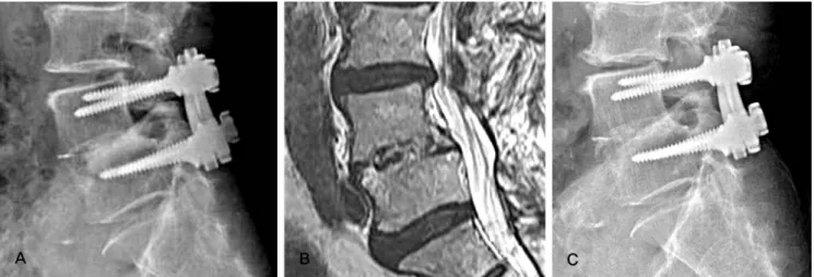 Table 3. The Changes of Disc Height on Lateral Radiograph