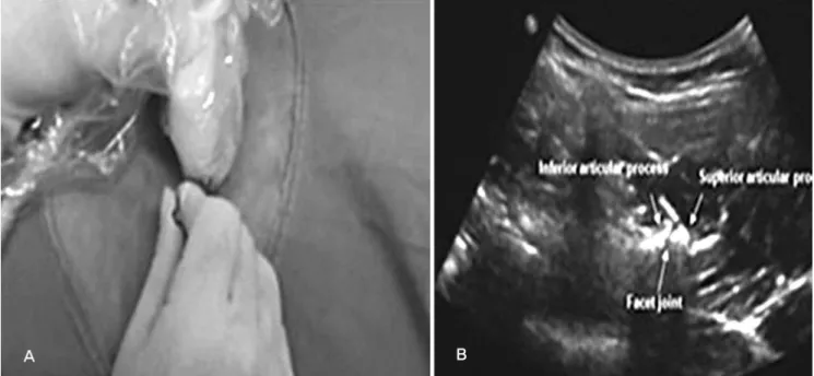 Fig. 1. All the procedures were performed with the patient in the prone position. (A) location of the needle at superiolateral edge of the lateral facet