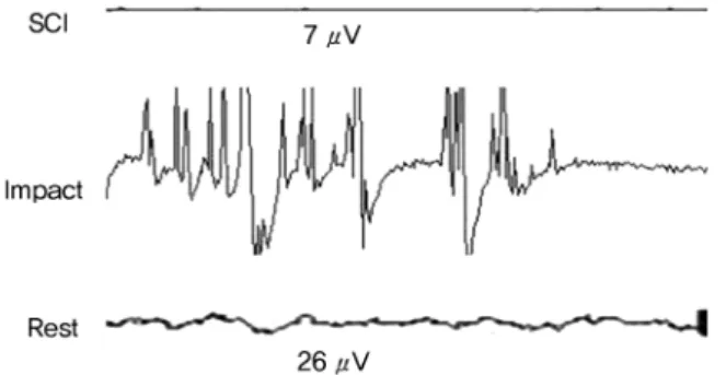 Fig. 1. EMG recorded after spinal cord inury in dog: Noted severe training wave  when spinal cord impacted