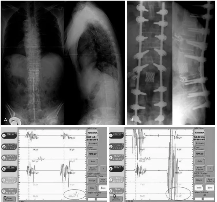 Fig. 2.(A) Male 57-years, ankylosing spondylitis with kyphosis (B) after PVCR and compression (C) channel 8 showed normal MEP response before PVCR (D) channel 8 showed  that amplitude was decreased above 80% at right lower limb immediately after PVCR and c