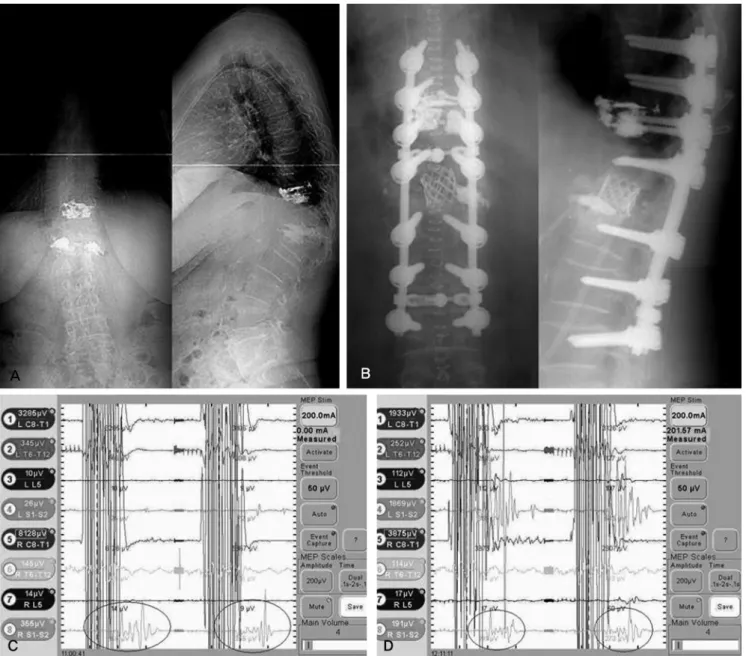 Fig. 3.(A) Female 66-years, post traumatic kyphosis (B) after decompression and PVCR (C) channel 8 showed normal MEP response before decompression and PVCR (D)  channel 8 showed normal MEP response after decompression and PVCR but she woke up with both low