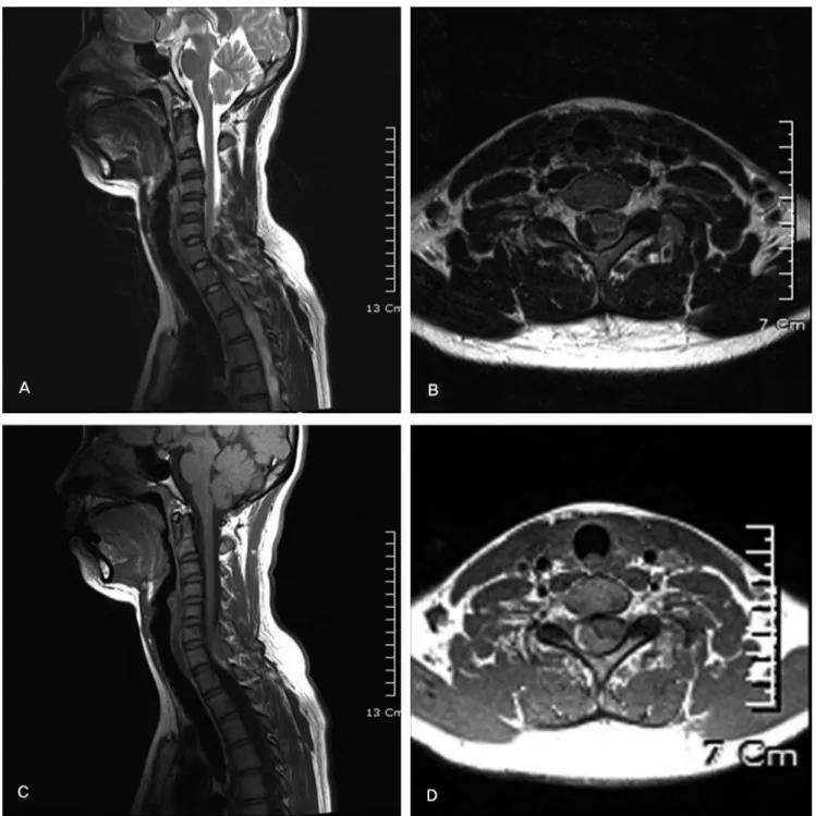 Fig. 1. MR images on the 3rd hospital day, demonstrating an epidural lesion at the dorsal C6~T1 level as a intermediate to low intensity area on the (A) T2-weighted sagittal  image (B) T2-weighted axial image and (C) intermediate to high intensity area on 
