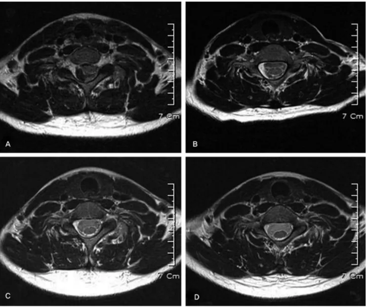 Fig. 2. Serial T2-weighted axial MR images, (A) Heterogeneous lobulated contour lesion compressed the spinal cord on the 3rd hospital day (B) On the 7th hospital day, a vary  thin low intensity lesion was observed at the hematoma site (C) One month later, 