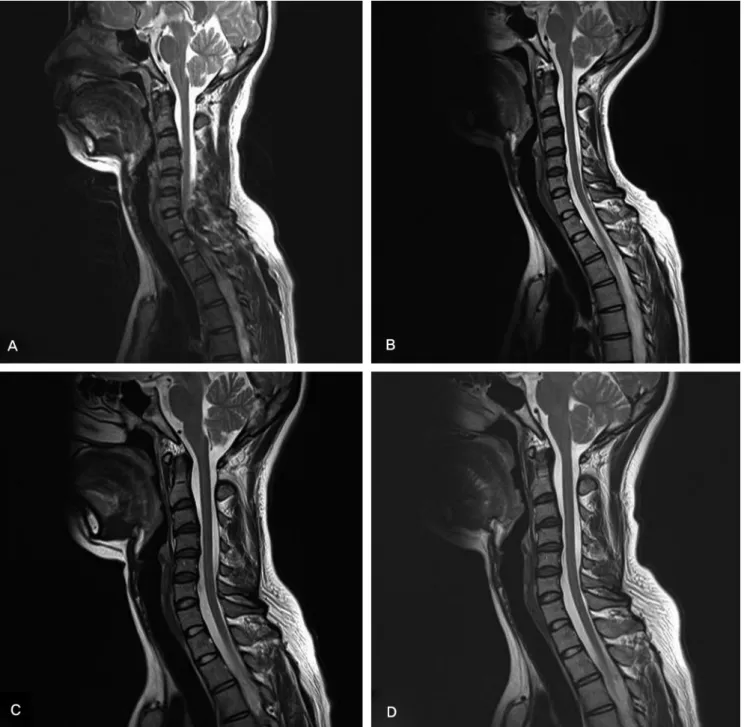 Fig. 3. Serial T2-weighted sagittal MR images, (A) Heterogeneous lobulated contour lesion compressed the spinal cord on the 3rd hospital day (B) On the 7th hospital day,  a vary thin low intensity lesion was observed at the hematoma site (C) One month late
