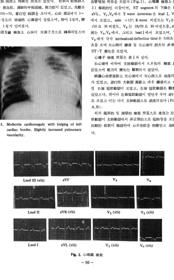 Fig.  1.  Moderole  cardiomegaly  with  bulging  of  left  cardiac  border.  Sligh t1 y  increased  pulmonary  vascularity