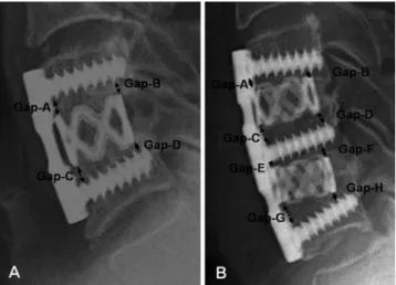 Fig. 3. Lateral radiograph of cervical spine showing cage subsidence  measuring method which is checked a difference of gap that right angle  distance from each edge of cage to screw for one level (A) and two levels (B).