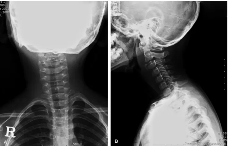 Fig. 2. Initial MRI. Acute symptomatic intervertebral disc calcification at C2-3 with right sided prevertebral hermiation of the calcification migrating  inferiorly (A) T2WI Axial view (B) T1WI Sagittal view