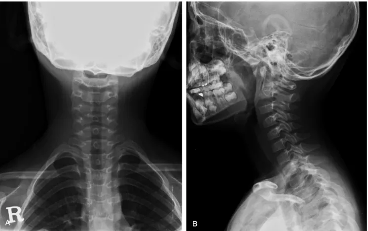 Fig. 4. F/U X-ray after 2 months. Detcreased intervertebral disc calcification at C2-3 (A) AP view (B) Lateral view