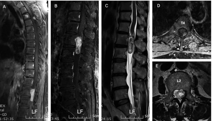 Fig. 2. T-spine CT scan image shows a ossification within the mass.