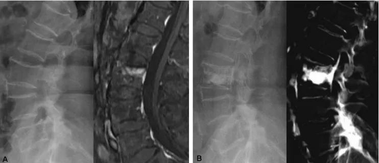 Fig. 1. (A) An 66-year-old female has recent osteoporotic compression fracture of L3. (B) Postoperative Lateral roentgenogram and Computed  tomography (CT) show leakage of PMMA.