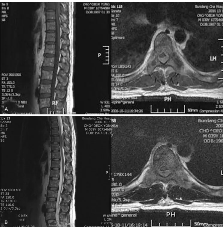 Fig. 1.  Magnetic resonance imaging showing epidural tumor compressing thoracic spinal cord