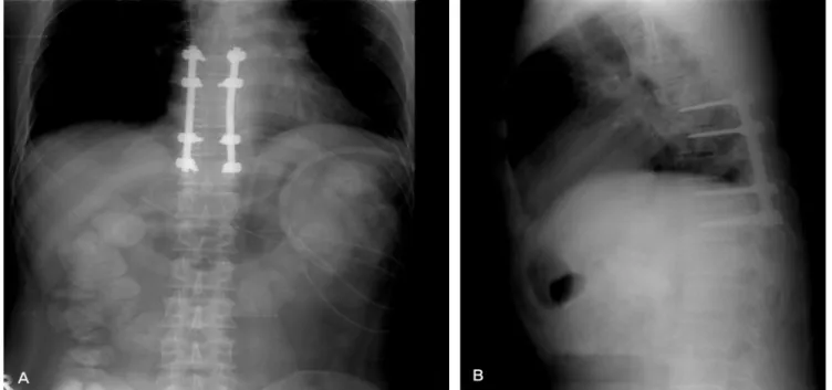 Fig. 2. Immediate postoperative x-rays after total laminectomy and posterior instrumentation