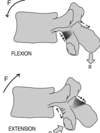 Fig. 2. Stress concentration on the pars during flexion and extension 