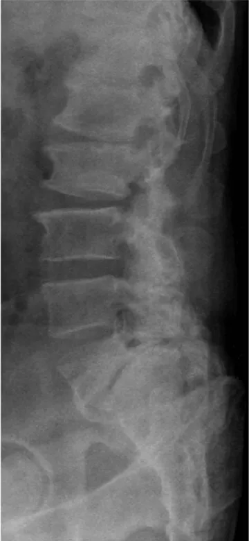 Fig. 5. Low dysplastic spondylolisthesis in 42-year-old man. Note the spur  formation on the anterior aspect of S1.