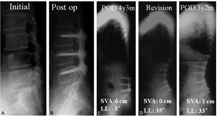 Fig. 3. A 65-year-old woman suffered from stenosis L3-4-5 and spondylolisthesis L3 on L4 (A) was treated with posterior decompression and posterior instrumentation from L3  to L5 (B)